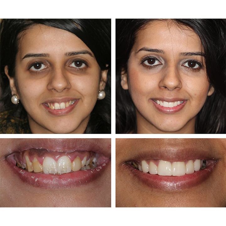 LIMETOW™ Teeth Whitening Essence